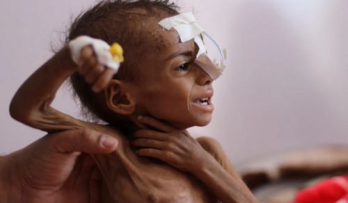 17 Million Hungry in Yemen, Between the Hell of Rulers and the Corruption of Organizations